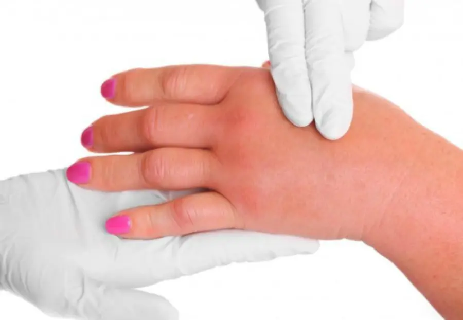 I Geloni, cosa sono, sintomi e rimedi