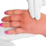 I Geloni, cosa sono, sintomi e rimedi