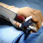 Leucemia, curati i primi pazienti con la terapia CAR-T